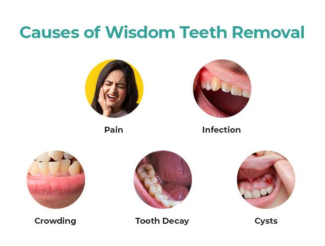 should you remove your wisdom teeth