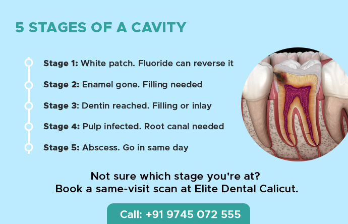 5-stages-of-a-cavity